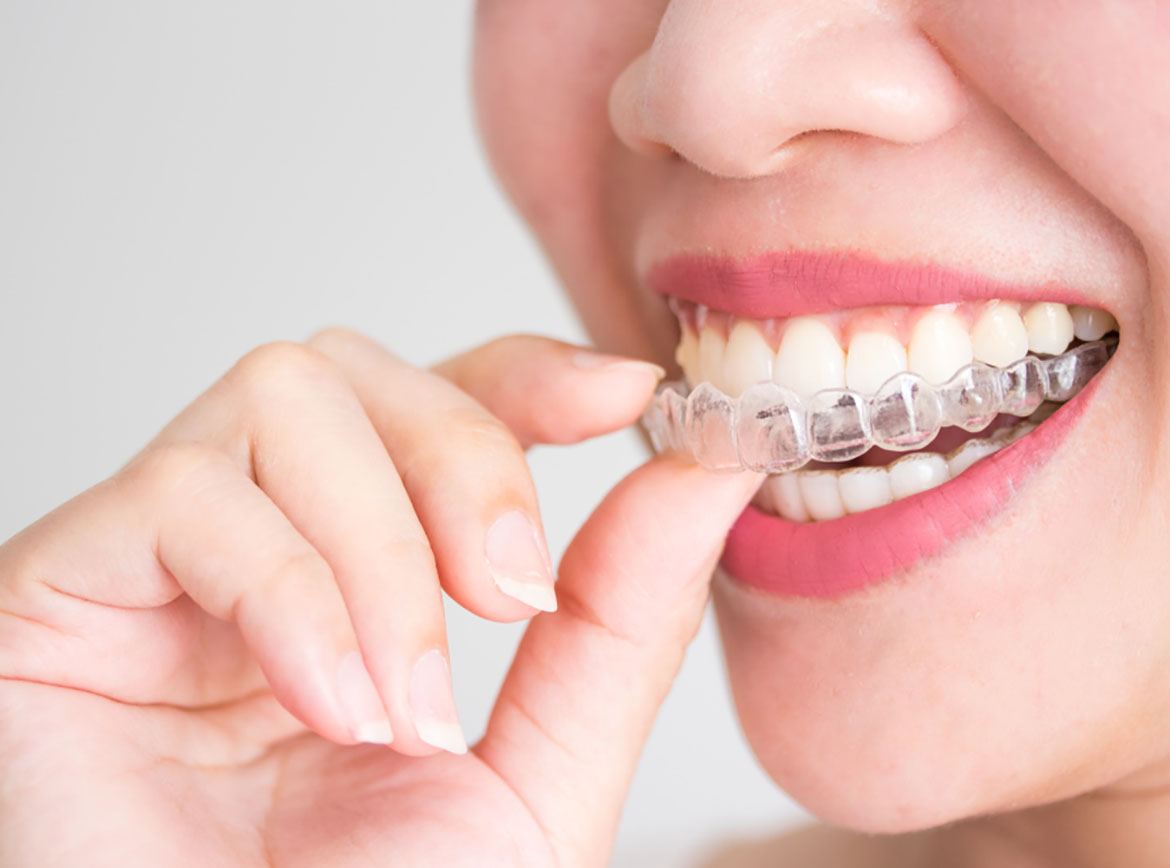 invisalign clear Banner