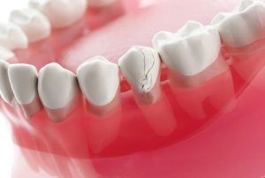Tooth Pain When Biting cracked tooth southport
