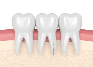 Cavity Cracked Tooth root